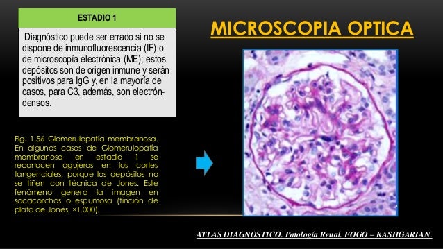 Glomerulonefritis Membranosa Pdf